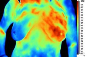 Medical Thermography Research Image Breast After Radiation Therapy Post Monitoring Holistic Integrated Healthcare Natural Medicine Center Lakeland Central Florida